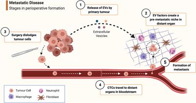 Perioperative Intravenous Lidocaine and Metastatic Cancer Recurrence - A Narrative Review